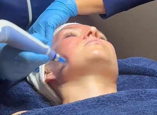 Forny hudens glød med microneedeling i Oslo – dette bør du vite